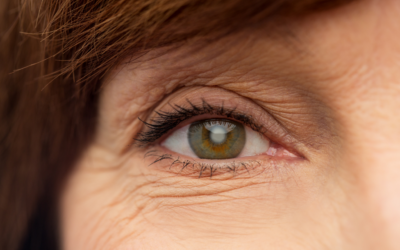 What to Expect from Cataract Surgery